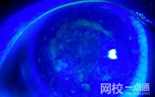 女子戴隱形10年角膜長(zhǎng)滿新生血管 具體是什么情況?