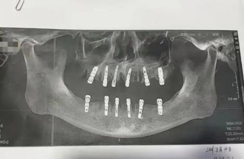 一次性拔牙23顆種12顆 13天后去世 實在太悲劇