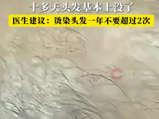 男子一月染頭4次致頭發(fā)大量脫落 實在太無奈了
