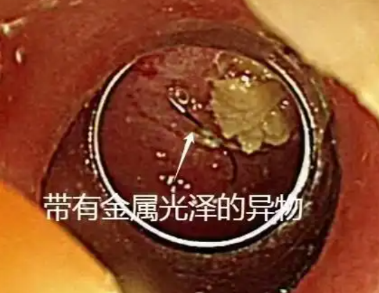 老人突發(fā)高燒拍胸片意外發(fā)現(xiàn)魚鉤 這也太恐怖了