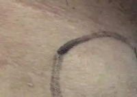 男子甲狀腺結(jié)節(jié)沒在意 2年后癌變 背后真相實在讓人驚愕