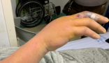 男子被香灰燒傷手指 險(xiǎn)喪失右手功能 這也太不注意了
