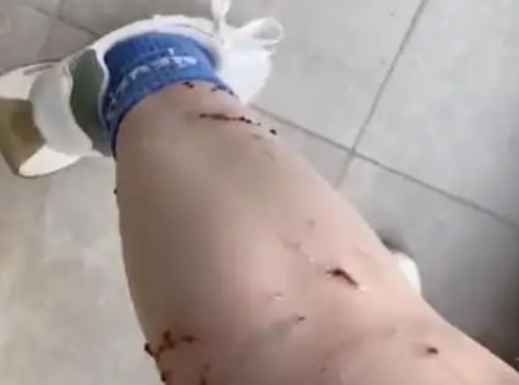 女子被寵物貓咬傷腿部潰爛 究竟是怎么回事？