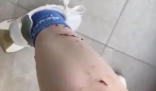 女子被寵物貓咬傷腿部潰爛 究竟是怎么回事？