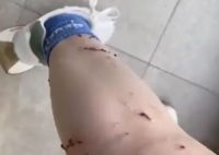 女子被寵物貓咬傷腿部潰爛 究竟是怎么回事？